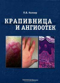 Крапивница и ангиоотек