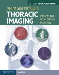 Pearls and Pitfalls in Thoracic Imaging: Variants and Other Difficult Diagnoses