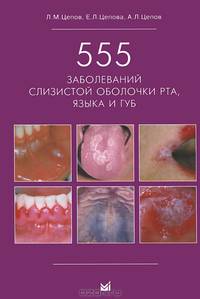 555 заболеваний слизистой оболочки рта, языка и губ