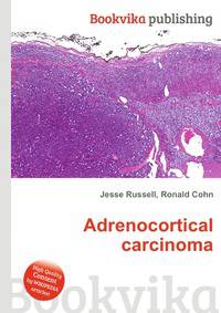 Adrenocortical carcinoma