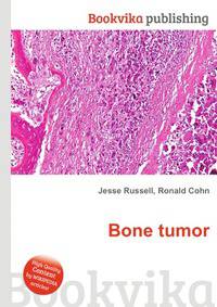 Bone tumor