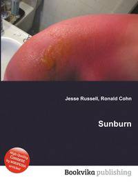 Sunburn