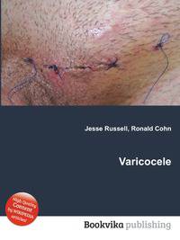 Varicocele