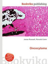 Oncocytoma