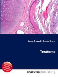 Teratoma
