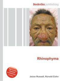 Rhinophyma
