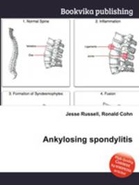 Ankylosing spondylitis