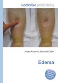 Edema