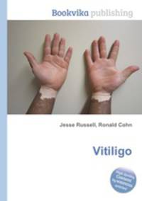 Vitiligo