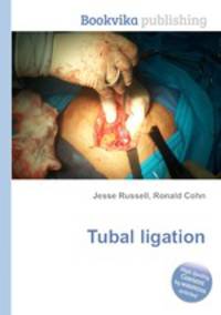 Tubal ligation