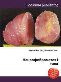Нейрофиброматоз I типа