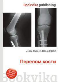 Перелом кости