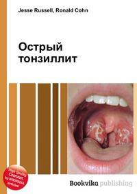 Острый тонзиллит
