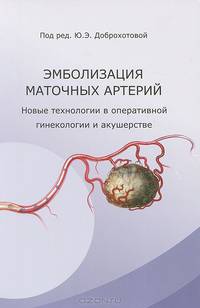 Эмболизация маточных артерий