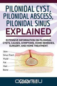 Pilonidal Cyst, Pilonidal Abscess, Pilonidal Sinus Explained. Extensive Information on Pilonidal Cysts, Causes, Symptoms, Home Remedies, Surgery, and Home Treatment.