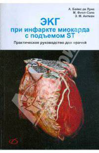 ЭКГ при инфаркте миокарда с подъемом ST
