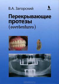 Перекрывающие протезы (overdentures)
