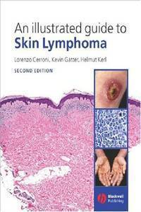 An Illustrated Guide to Skin Lymphoma. 3ed.2004