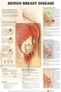 Benign Breast Disease Anatomical Chart