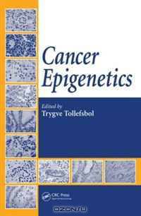 Cancer Epigenetics