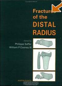 Fractures of the Distal Radius