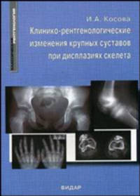 Клинико-рентгенологические изменения крупных суставов при дисплазиях скелета