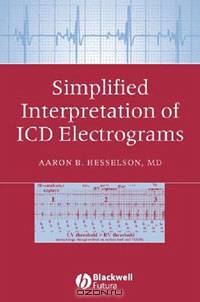 Simplified Interpretation of ICD Electrograms