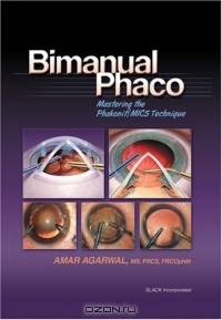 Bimanual Phaco: Mastering The Phakonit/MICS Technique