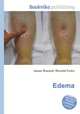Edema, Jesse Russell,Ronald Cohn 