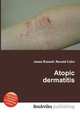 Atopic dermatitis, Jesse Russell,Ronald Cohn 