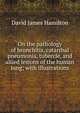 On the pathology of bronchitis, catarrhal pneumonia, tubercle, and allied lesions of the human lung; with illustrations, David James Hamilton 