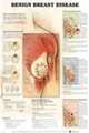 Benign Breast Disease Anatomical Chart, ACC 