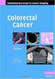 Colorectal Cancer, Editor by Gina Brown 